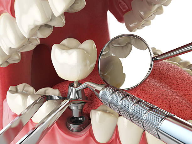 Best Emergency Dentist for Lost Fillings or Crowns in Canton, OH